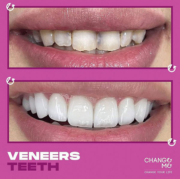 implant-before-after-2
