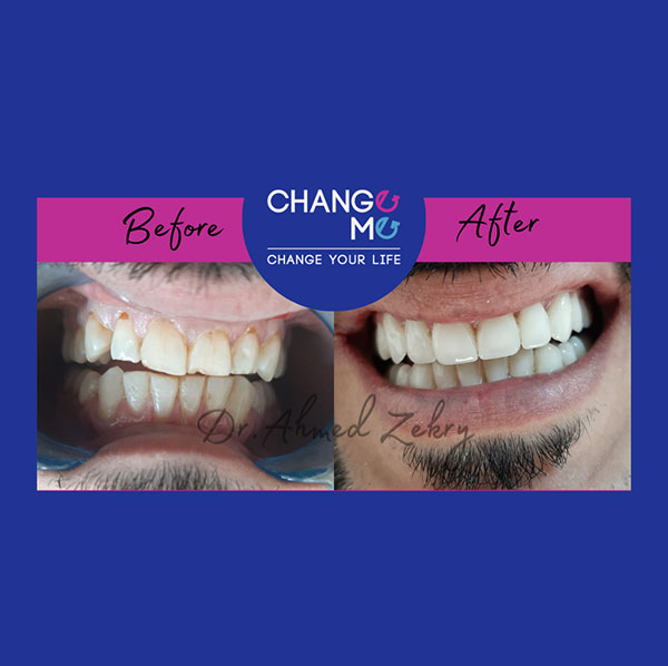implant-before-after-3