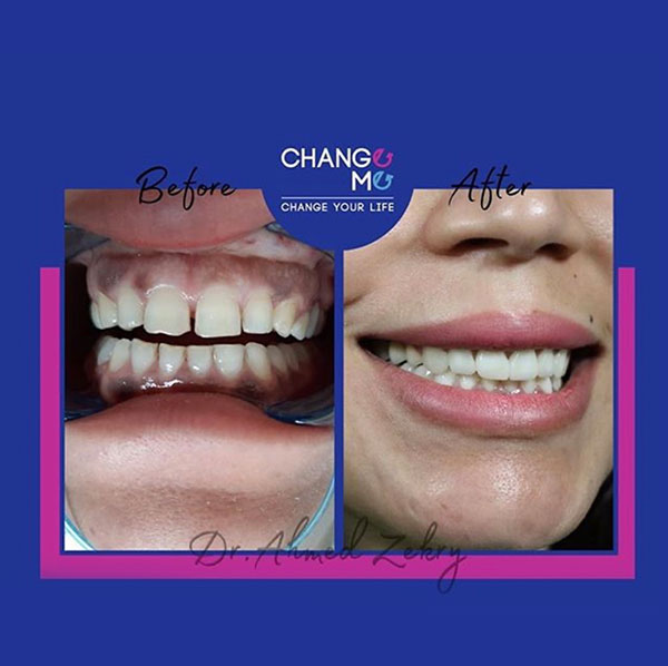 implant-before-after-4