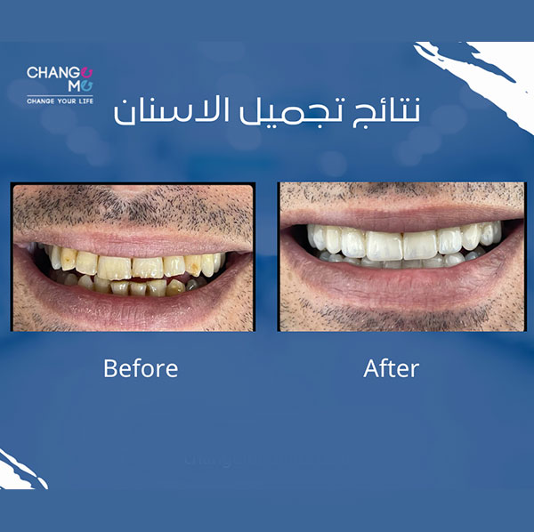 implant-before-after