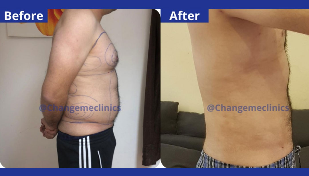 lipo-before-after-2