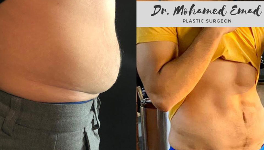 lipo-before-after