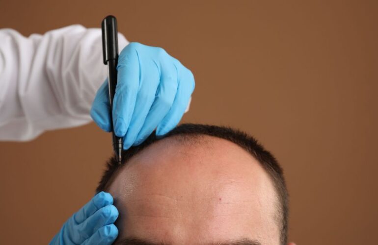 زراعة الشعر بتقنية DHI