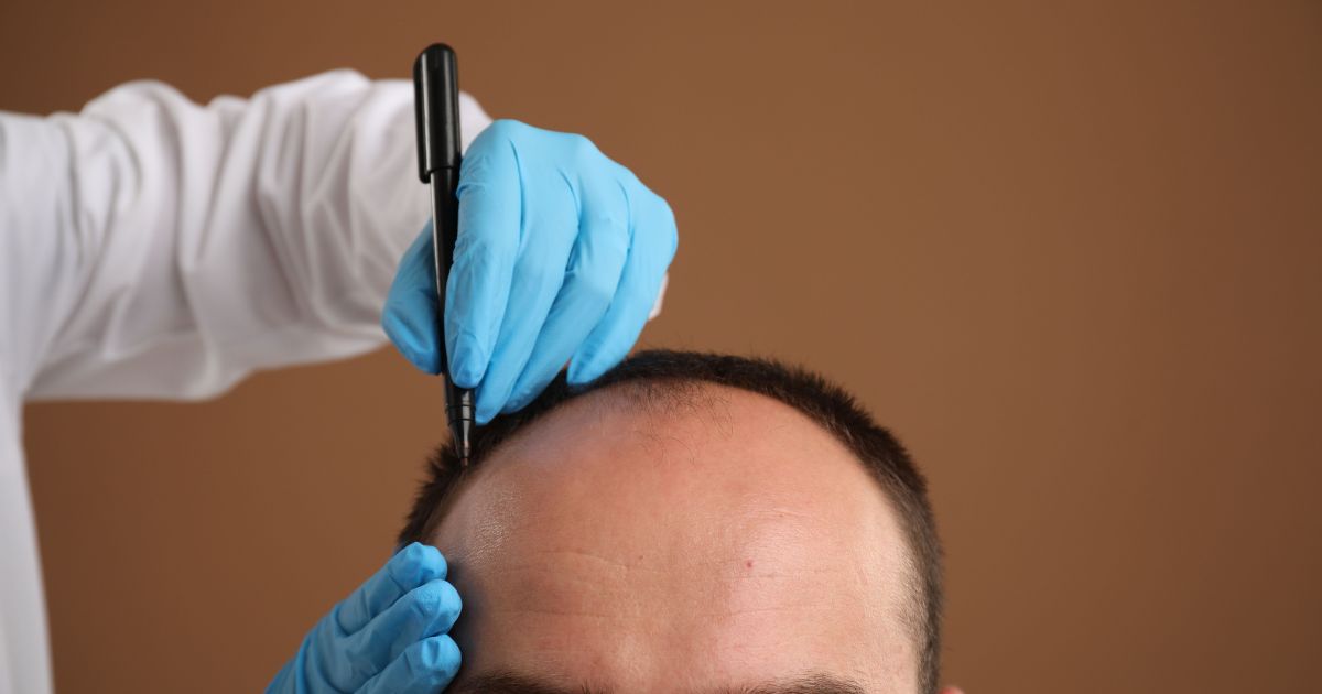 زراعة الشعر بتقنية DHI