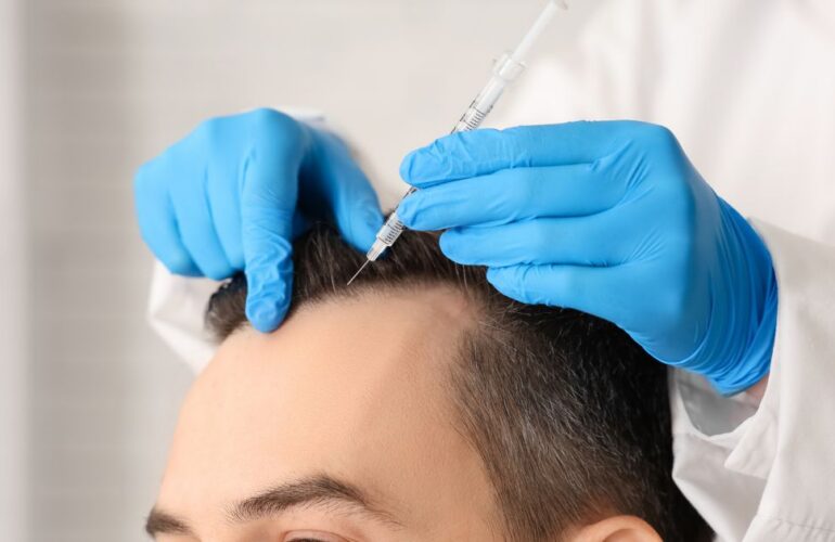 تكلفة زراعة الشعر في مصر
