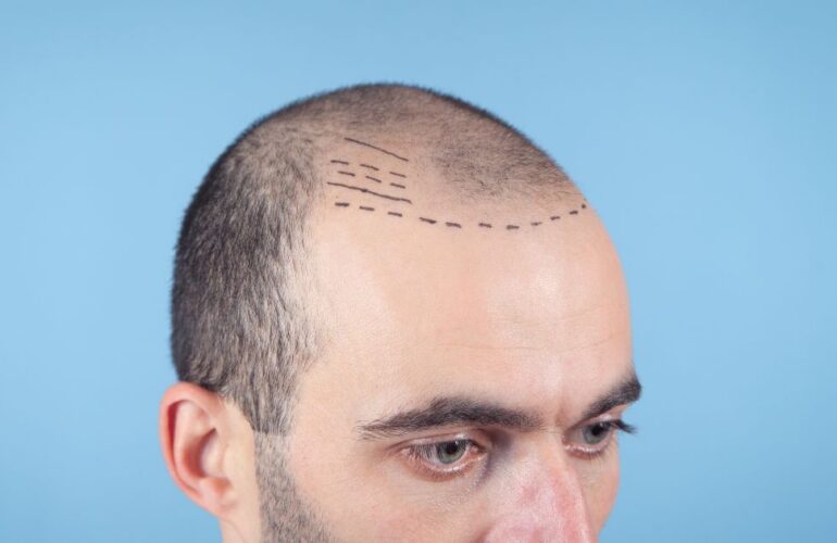 الممنوعات بعد زراعة الشعر