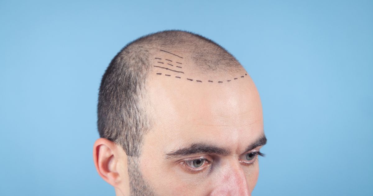 الممنوعات بعد زراعة الشعر