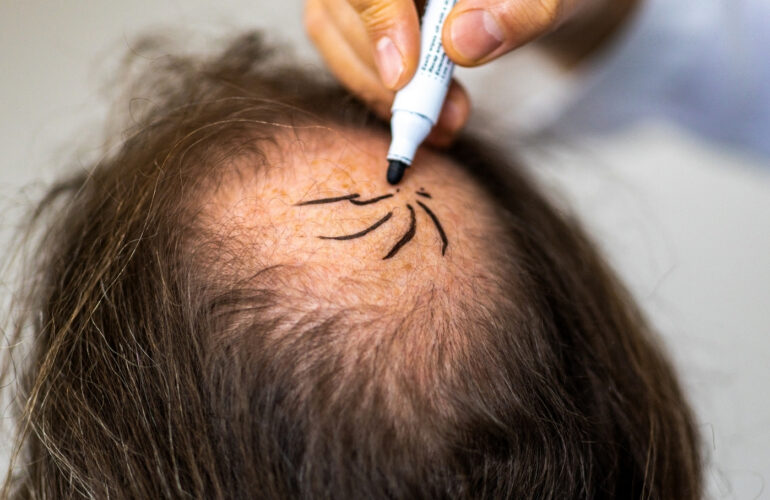 عملية زراعة الشعر