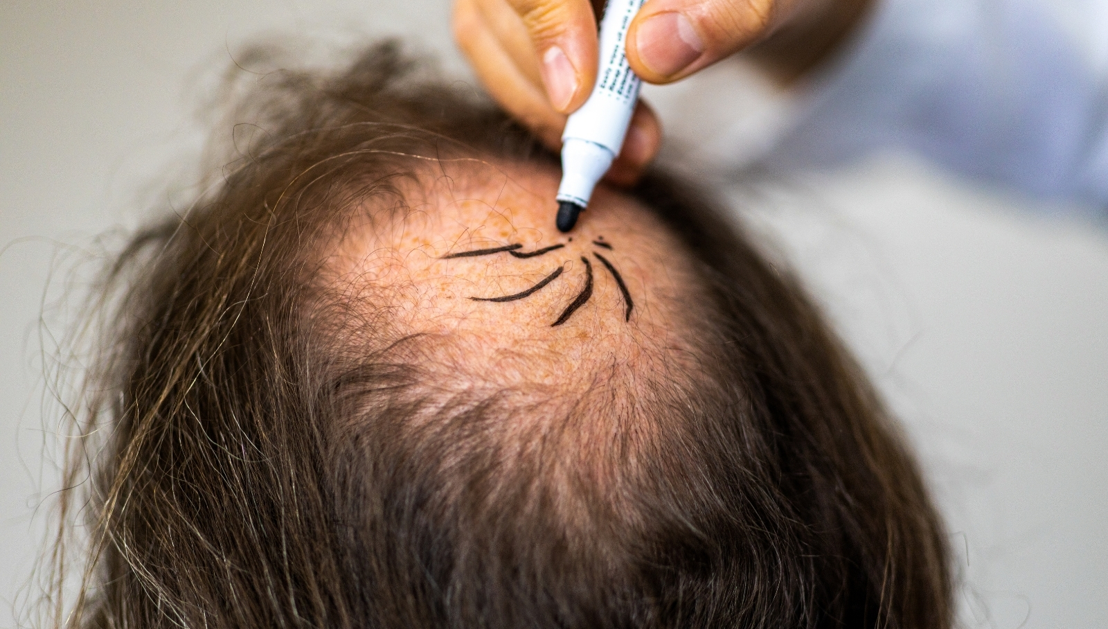 عملية زراعة الشعر