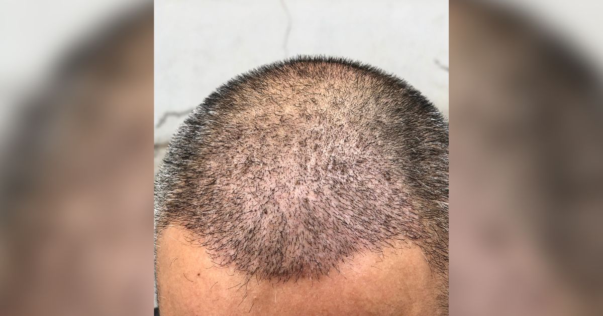 كم عدد جلسات زراعة الشعر
