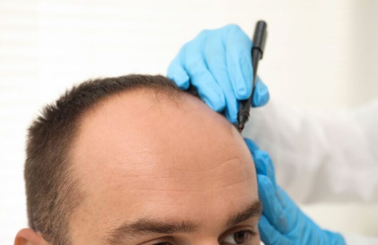 تقنيات زراعة الشعر