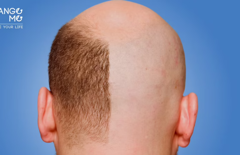 تقنيات زراعة الشعر في مصر