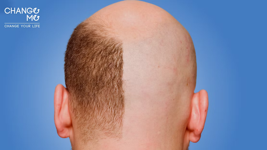 تقنيات زراعة الشعر في مصر