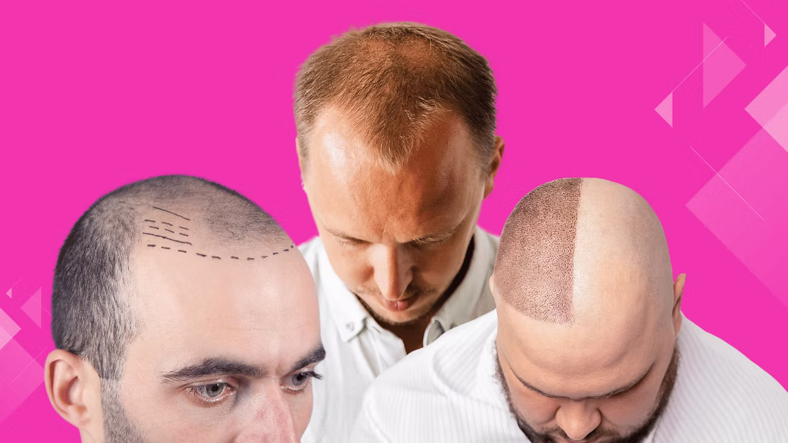 السن المناسب لزراعة الشعر
