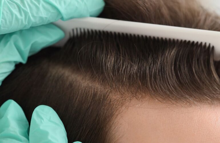 زراعة الشعر الطبيعي