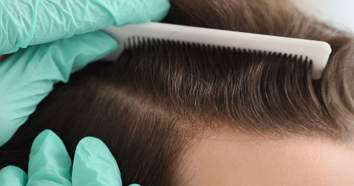 زراعة الشعر الطبيعي