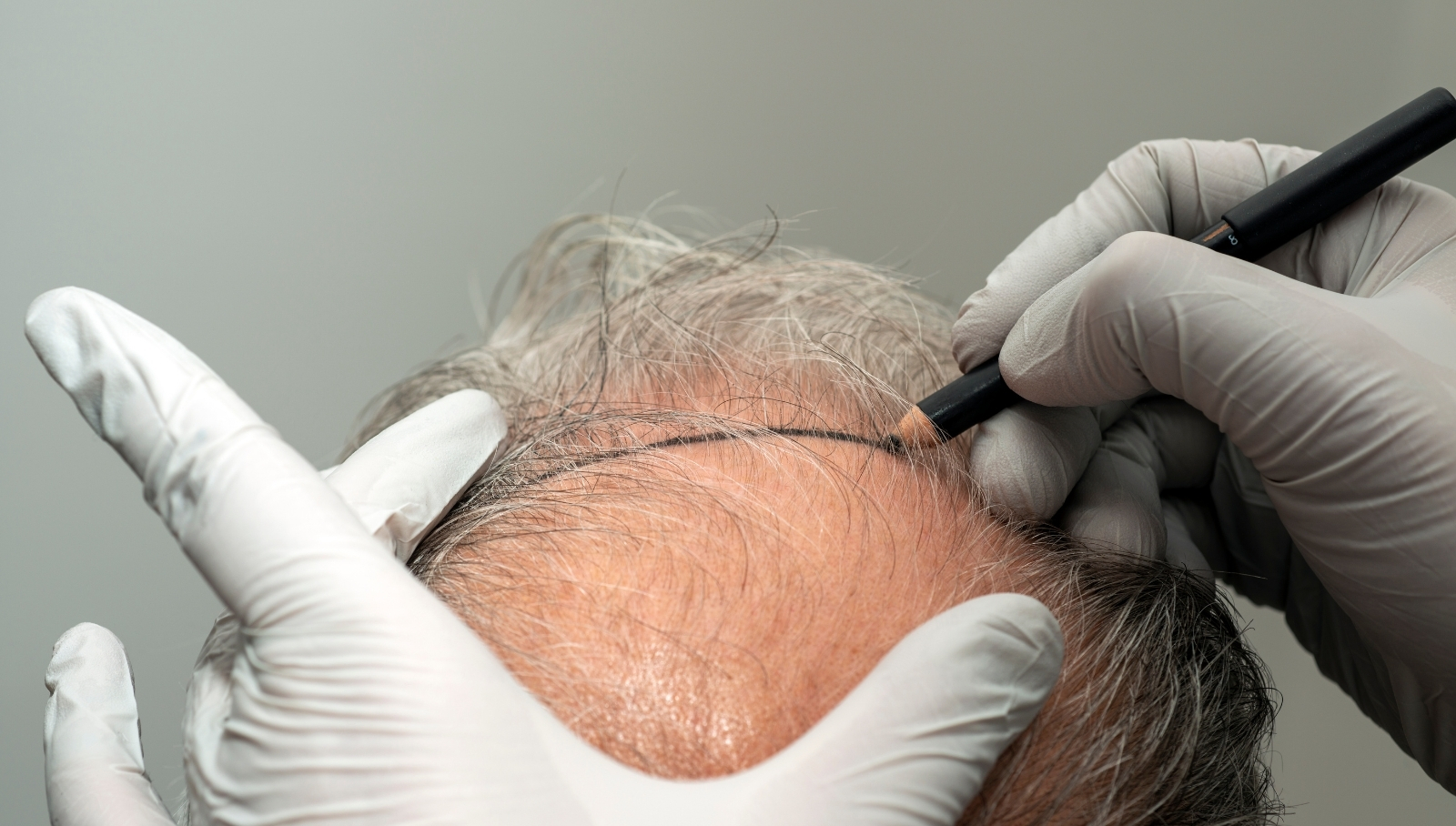 زراعة الشعر الطبيعي