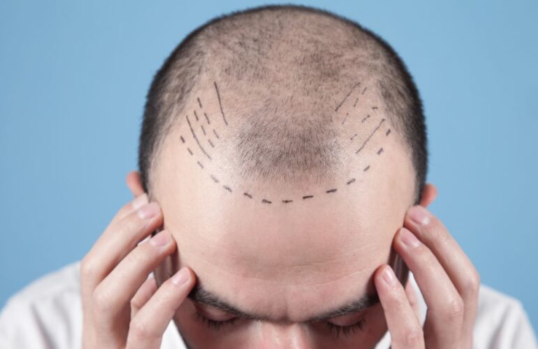 نتائج زراعة الشعر بعد 3 شهور