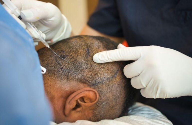 زراعة الشعر في أماكن الجروح