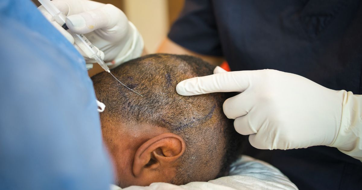 زراعة الشعر في أماكن الجروح