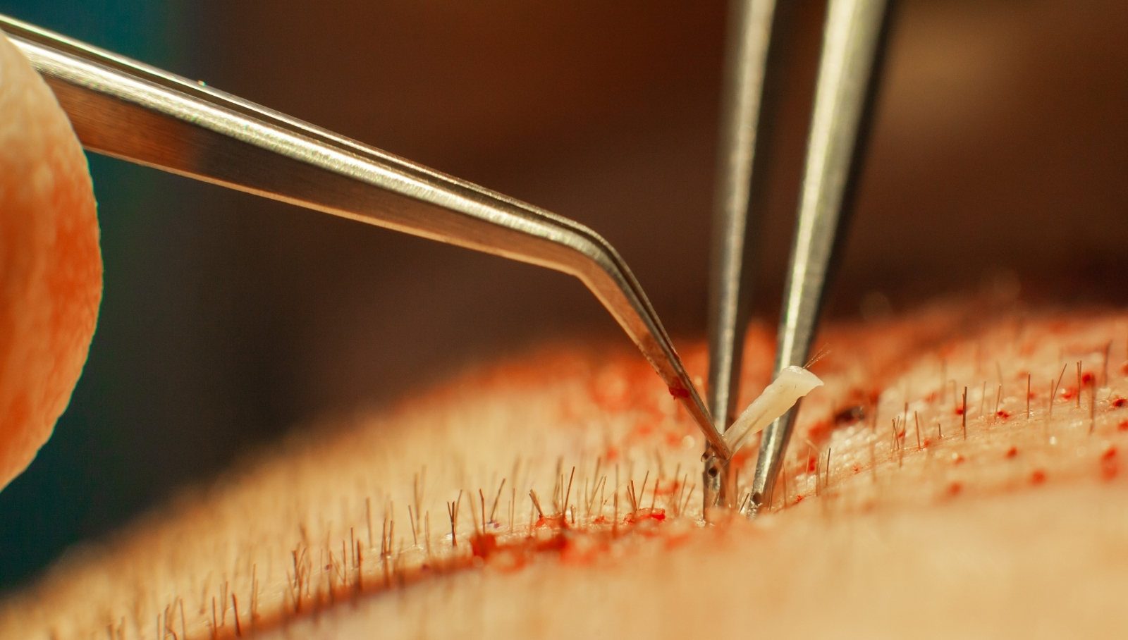 فوائد ومخاطر عمليات زراعة الشعر