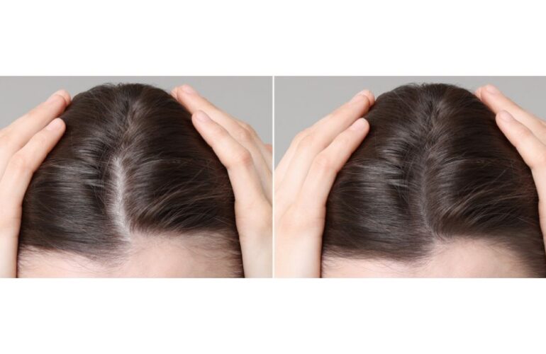 تجربتي مع زراعة الشعر في مصر