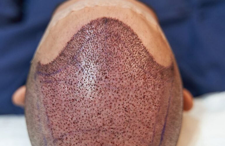 زراعة الشعر بتقنية FUE