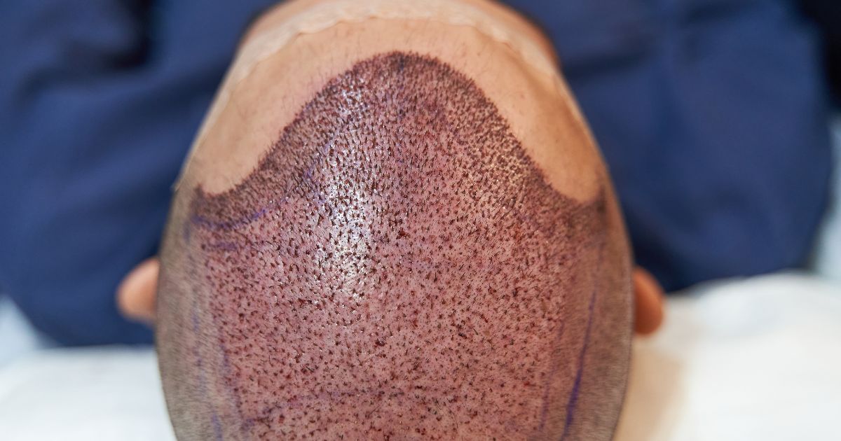 زراعة الشعر بتقنية FUE