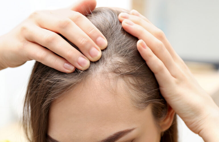 زراعة شعر مقدمة الرأس للنساء
