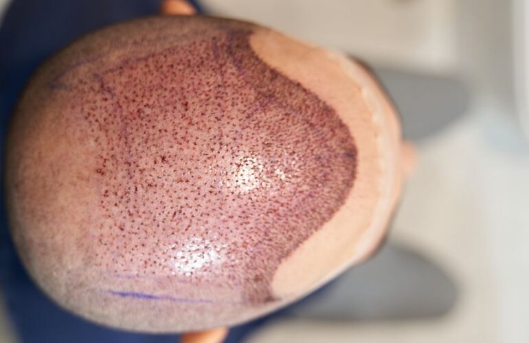فترة الشفاء بعد عملية زراعة الشعر