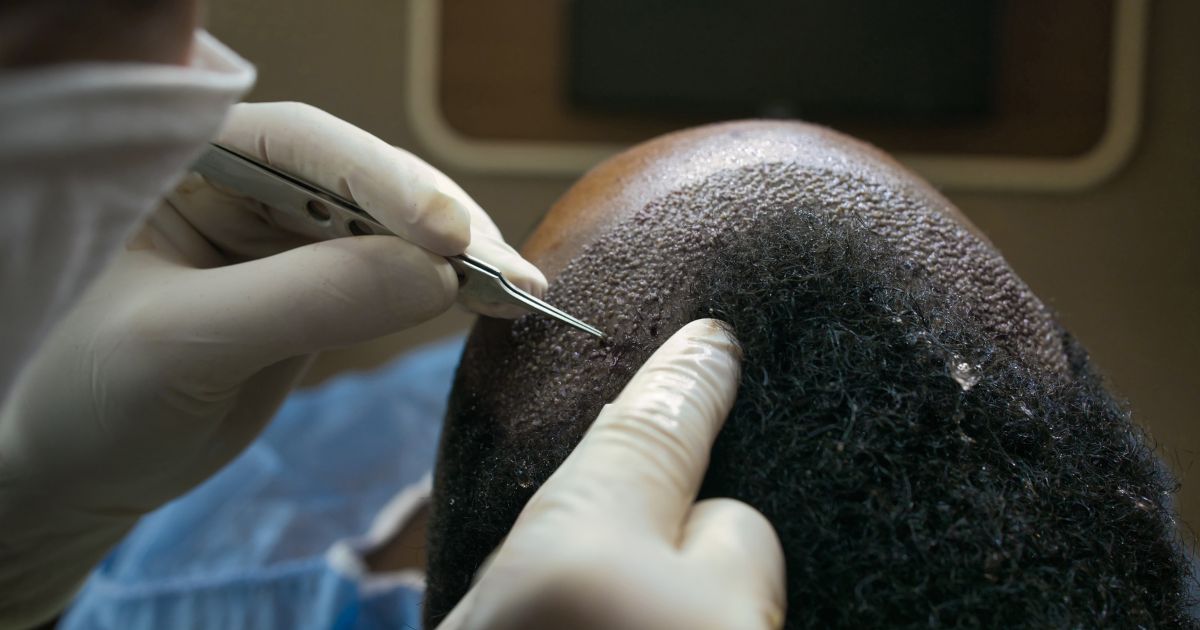 اسئلة شائعة عن عملية زراعة الشعر في مصر