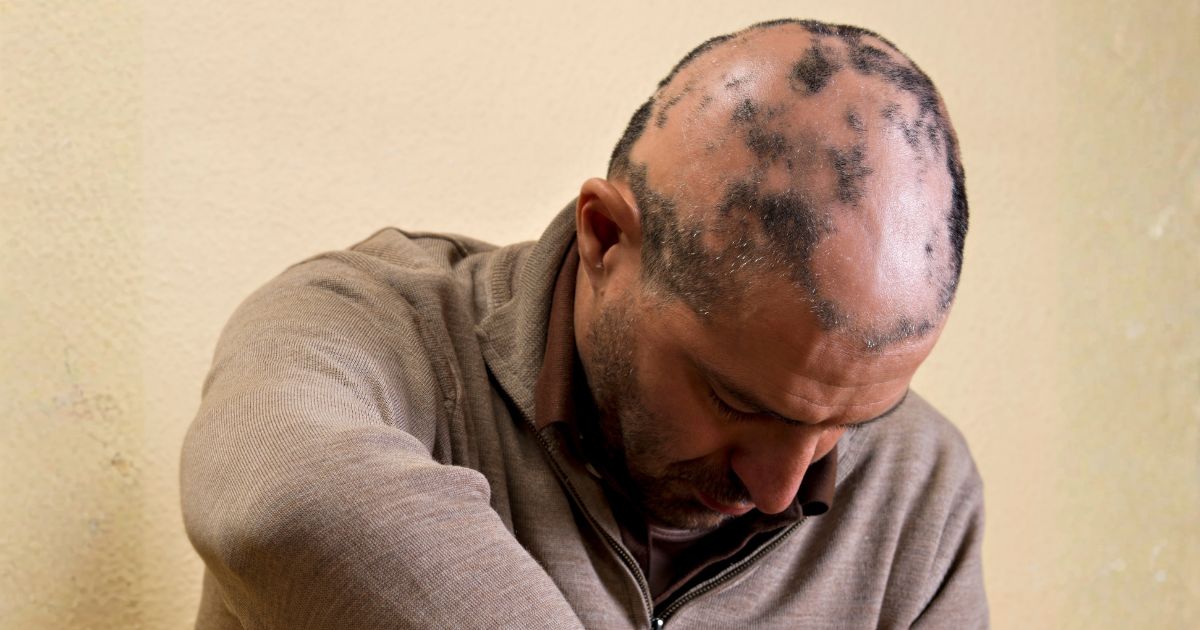 الثعلبة عند الرجال