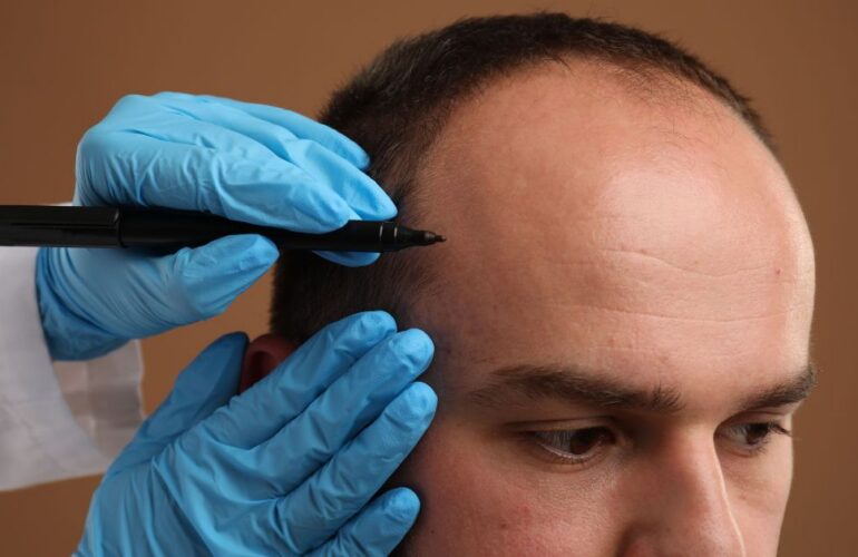 أسعار عمليات زرع الشعر