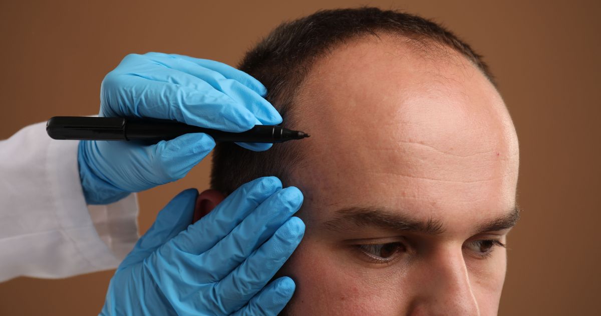 أسعار عمليات زرع الشعر