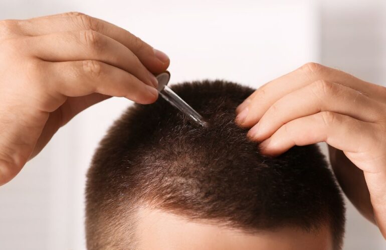 أنواع عمليات زراعة الشعر