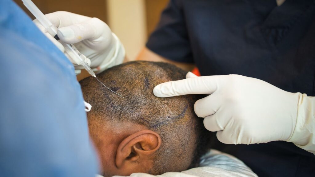 عملية زراعة الشعر