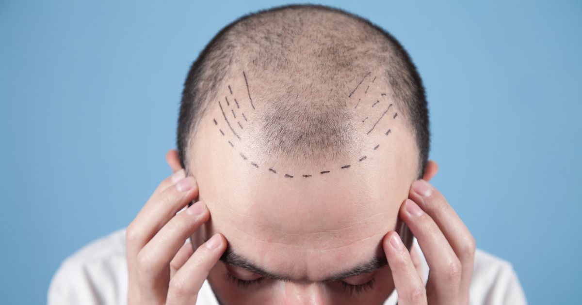 مراكز زراعة الشعر فى مصر